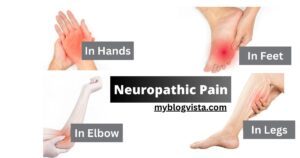 Neuropathic Pain